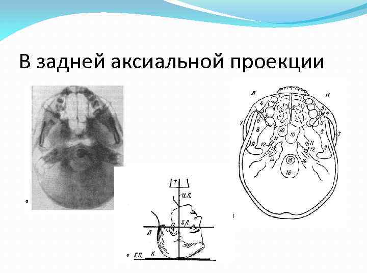 Аксиальная проекция. Аксиальная проекция черепа кт. Аксиальная проекция черепа рентгенограмма. Аксиальная проекция черепа укладка. Задняя полуаксиальная проекция черепа.