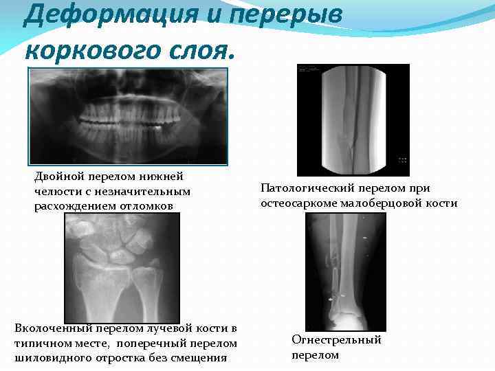 Деформация и перерыв коркового слоя. Двойной перелом нижней челюсти с незначительным расхождением отломков Вколоченный