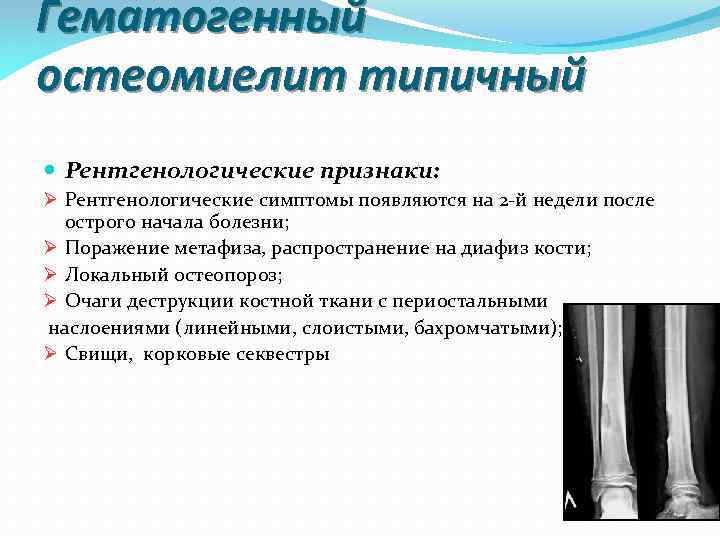 Клинически острый гематогенный остеомиелит проявляется. Гематогенный остеомиелит плечевой кости рентген.