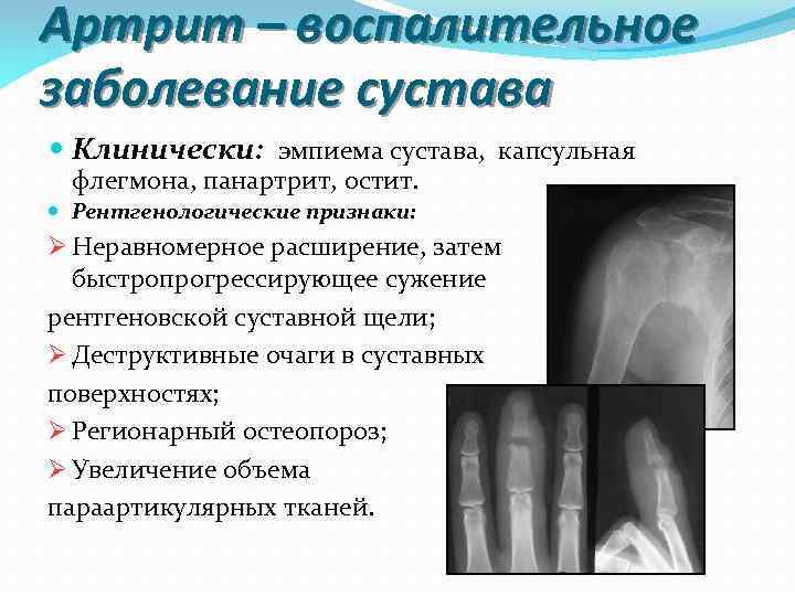 Признаки артрита. Рентгенологические признаки артрита. Артрит рентген признаки. Рентгенологические симптомы поражения суставов.. Воспалительный артрит на рентгене.