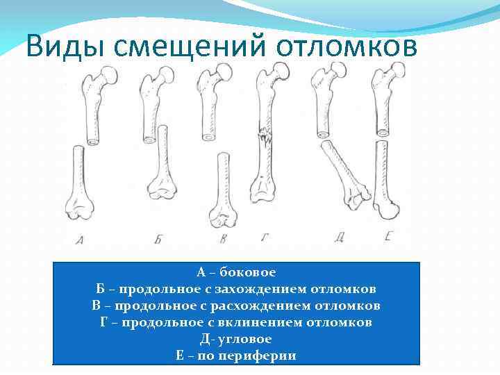 Смещение отломков кости