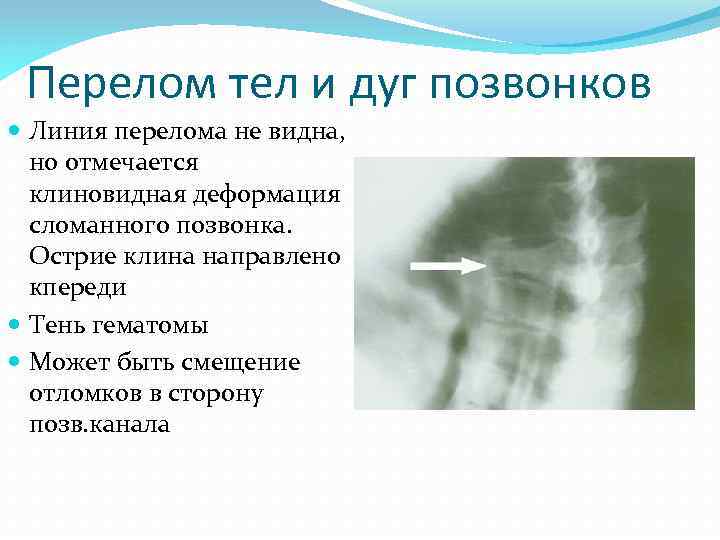 Перелом тел и дуг позвонков Линия перелома не видна, но отмечается клиновидная деформация сломанного