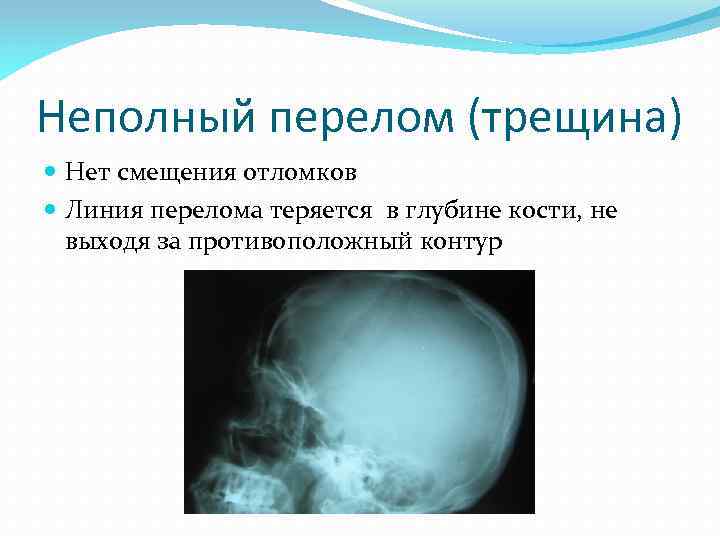 Неполный перелом (трещина) Нет смещения отломков Линия перелома теряется в глубине кости, не выходя