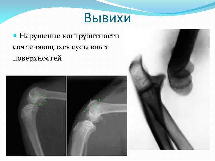 Суставные поверхности конгруэнтны. Конгруэнтность суставных поверхностей плечевого сустава. Конгруэнтность плечевого сустава нарушение. Нарушение конгруэнтности суставных поверхностей. Нарушение конгруэнтность суставных поверхностей костей.