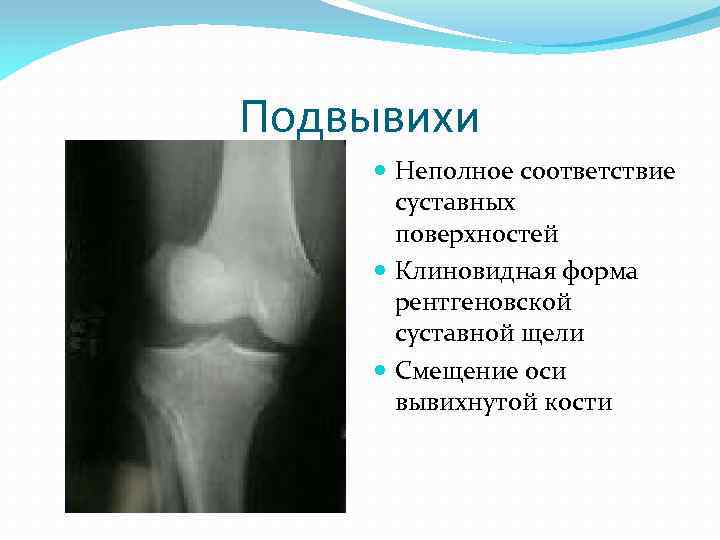 Подвывихи Неполное соответствие суставных поверхностей Клиновидная форма рентгеновской суставной щели Смещение оси вывихнутой кости