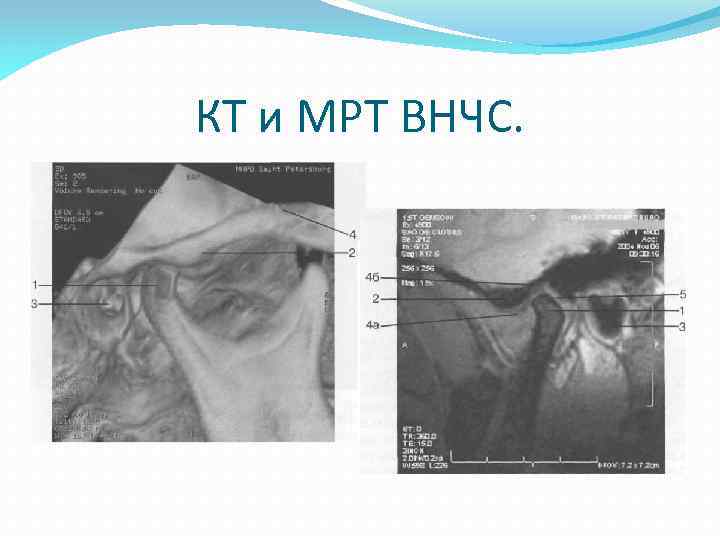 Презентация мрт внчс