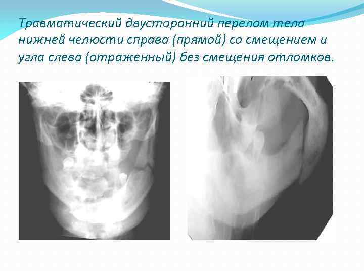 Травматический двусторонний перелом тела нижней челюсти справа (прямой) со смещением и угла слева (отраженный)