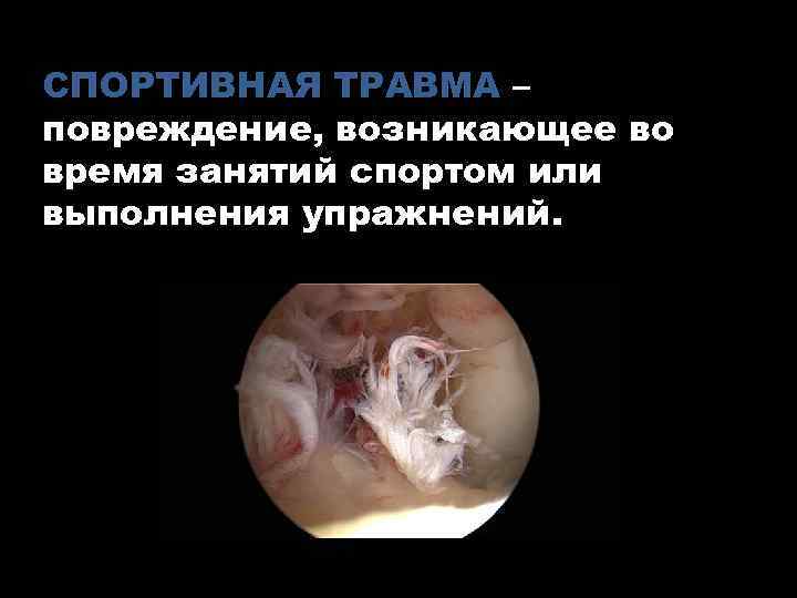 СПОРТИВНАЯ ТРАВМА – повреждение, возникающее во время занятий спортом или выполнения упражнений. 