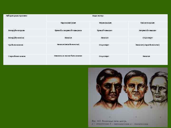 Лабораторные признаки Виды желтух Паренхиматозная Механическая Гемолитическая Билирубин в крови Прямой и непрямой повышены