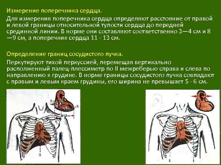 Относительная тупость сердца. Поперечник относительной тупости сердца в норме. Длинник и поперечник сердца. Норма поперечника сердца и сосудистого пучка. Границы сосудистого пучка сердца.