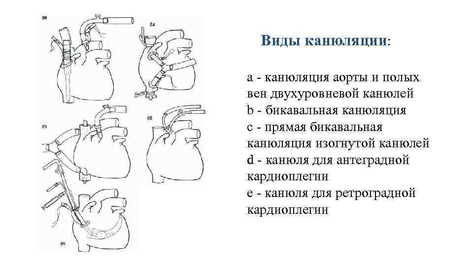 Виды канюляции: a - канюляция аорты и полых вен двухуровневой канюлей b - бикавальная