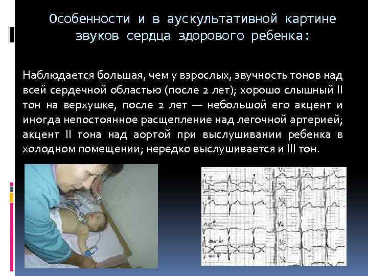 Особенности и в аускультативной картине звуков сердца здорового ребенка: Наблюдается большая, чем у взрослых,