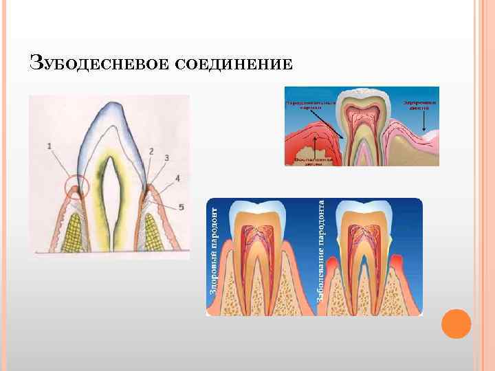 ЗУБОДЕСНЕВОЕ СОЕДИНЕНИЕ 