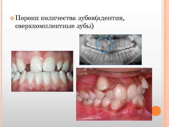  Пороки количества зубов(адентия, сверхкомплектные зубы) 