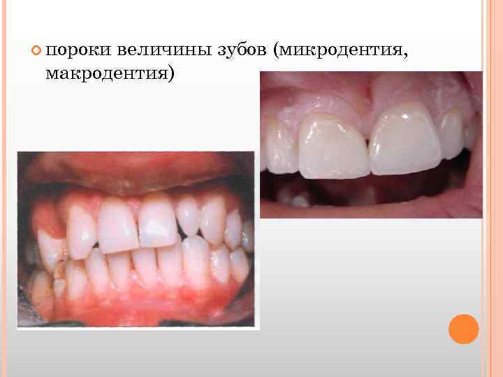 пороки величины зубов (микродентия, макродентия) 