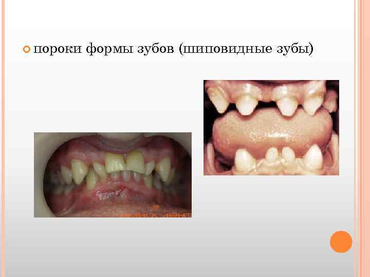  пороки формы зубов (шиповидные зубы) 