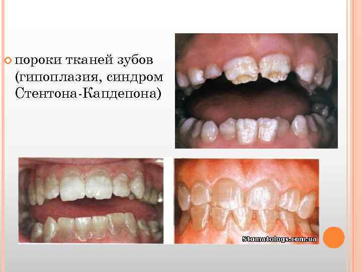  пороки тканей зубов (гипоплазия, синдром Стентона-Капдепона) 