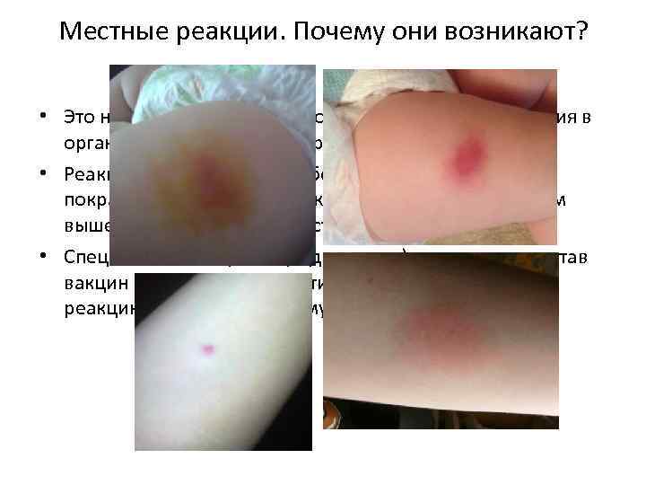 Местные реакции. Почему они возникают? • Это нормально – реакция воспаления в месте введения