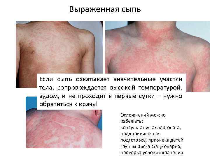 Выраженная сыпь Если сыпь охватывает значительные участки тела, сопровождается высокой температурой, зудом, и не