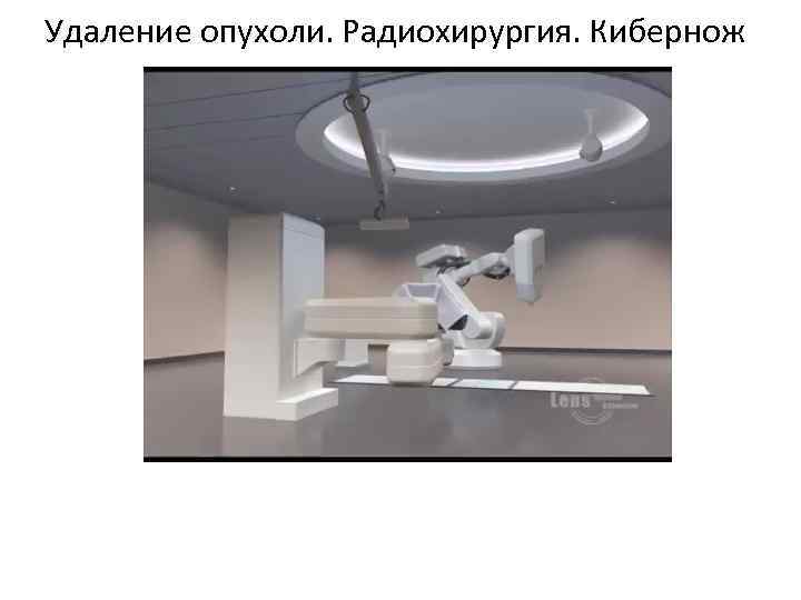 Удаление опухоли. Радиохирургия. Кибернож 