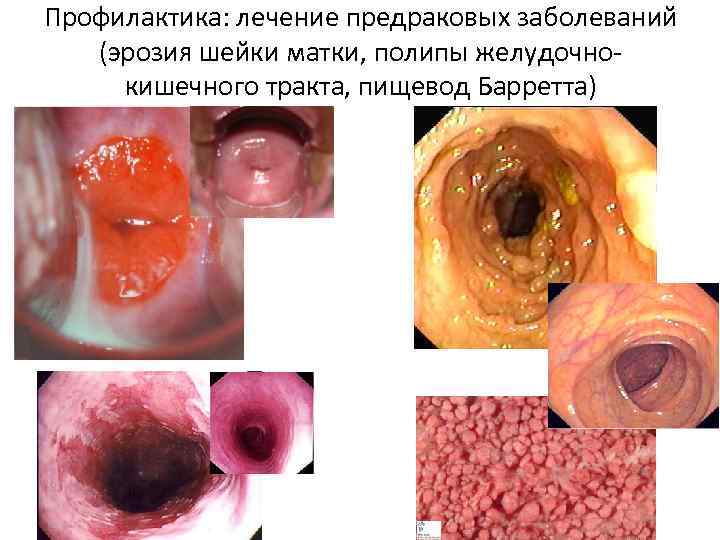 Профилактика: лечение предраковых заболеваний (эрозия шейки матки, полипы желудочнокишечного тракта, пищевод Барретта) 