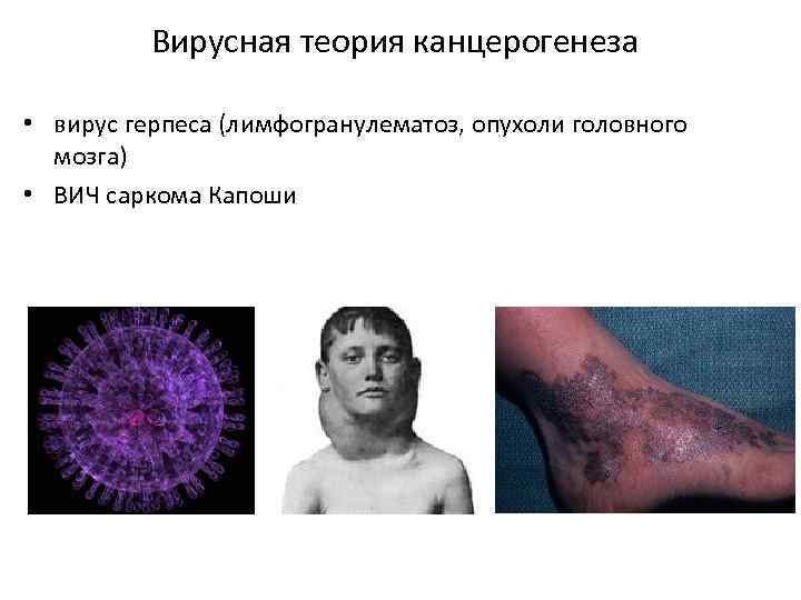 Вирусная теория канцерогенеза • вирус герпеса (лимфогранулематоз, опухоли головного мозга) • ВИЧ саркома Капоши