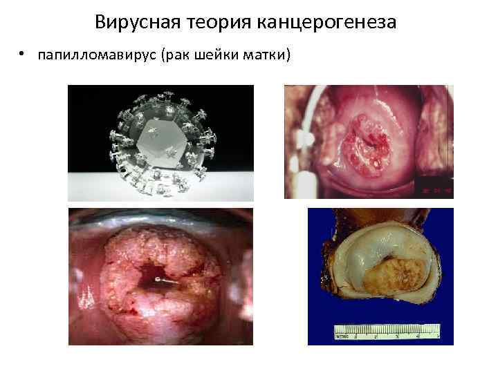 Вирусная теория канцерогенеза • папилломавирус (рак шейки матки) 