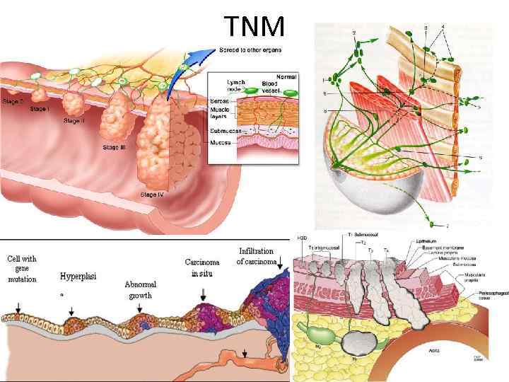 TNM 