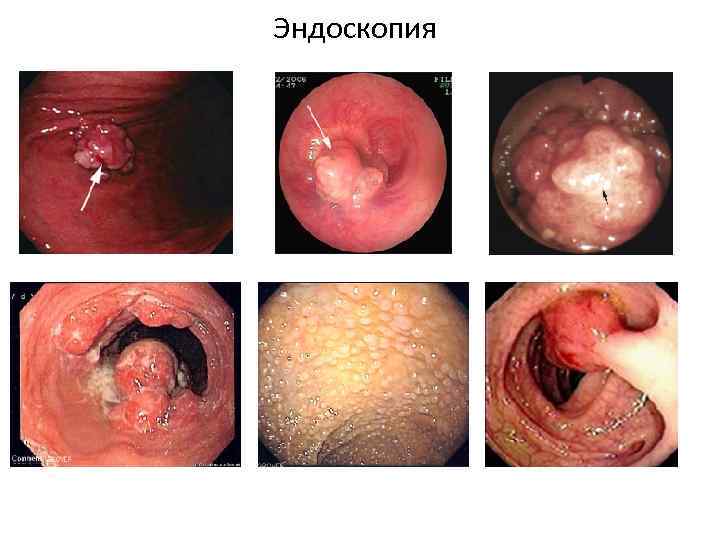 Эндоскопия 
