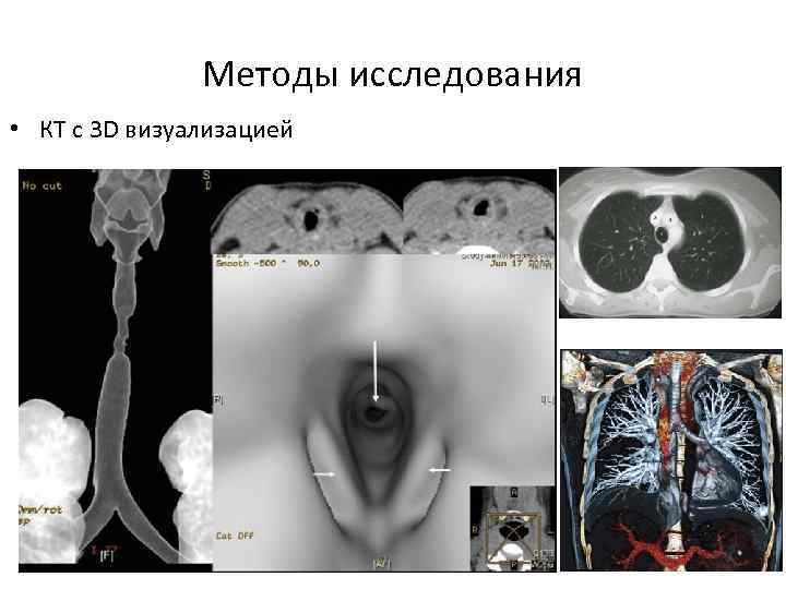 Методы исследования • КТ с 3 D визуализацией 