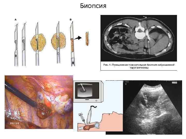 Биопсия 
