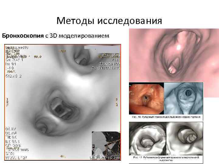 Методы исследования Бронхоскопия с 3 D моделированием 