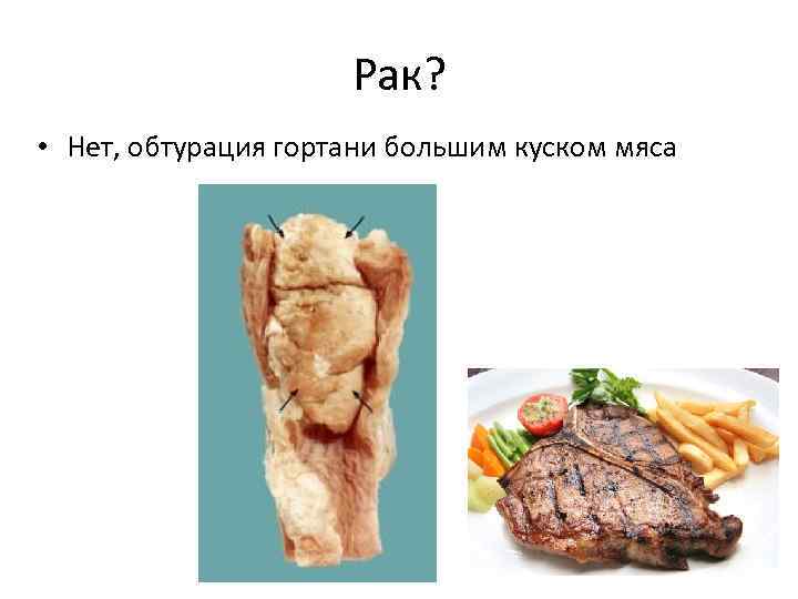 Рак? • Нет, обтурация гортани большим куском мяса 