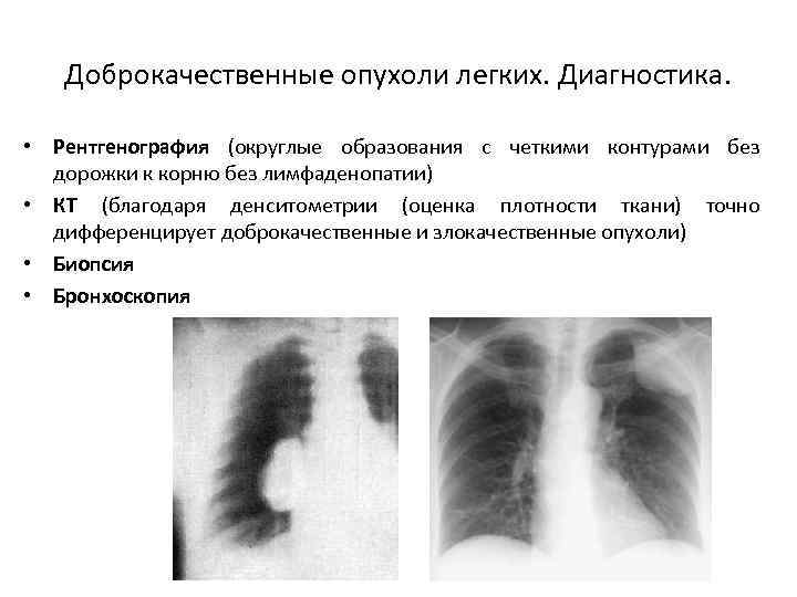 С ровными четкими контурами. Доброкачественная опухоль легкого рентген. Рентгенологические признаки доброкачественных опухолей в легких. Рентгенография опухоли легкого доброкачественное. Рентгенологические признаки доброкачественной опухоли в легком.