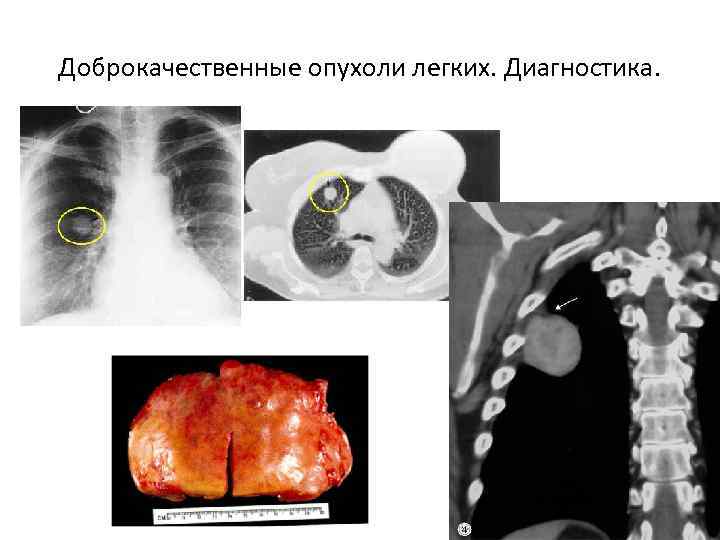 Доброкачественные опухоли легких. Диагностика. 