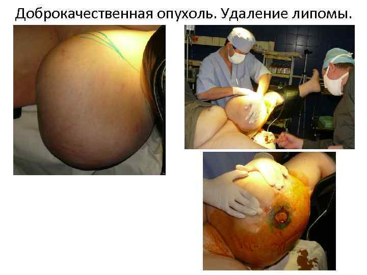 Доброкачественная опухоль. Удаление липомы. 