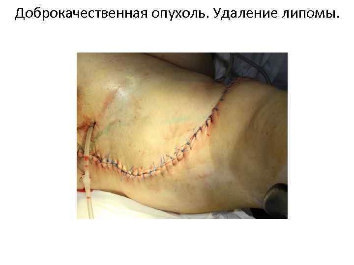 Доброкачественная опухоль. Удаление липомы. 
