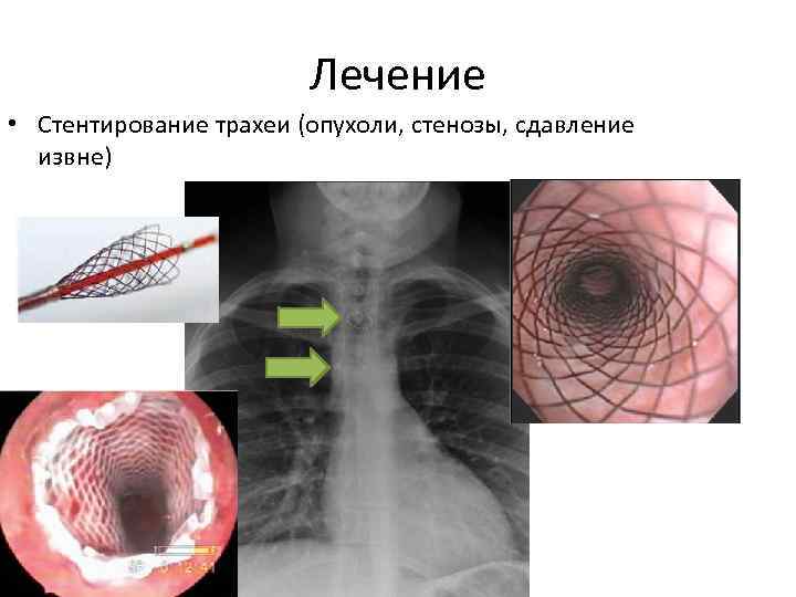 Лечение • Стентирование трахеи (опухоли, стенозы, сдавление извне) 