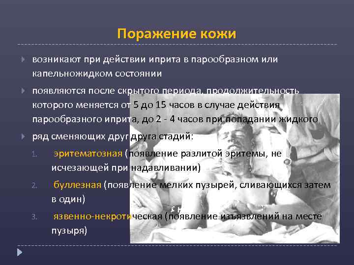 Поражение кожи возникают при действии иприта в парообразном или капельножидком состоянии появляются после скрытого