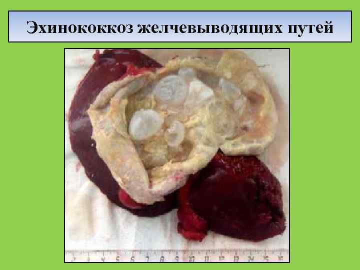 Эхинококкоз желчевыводящих путей 