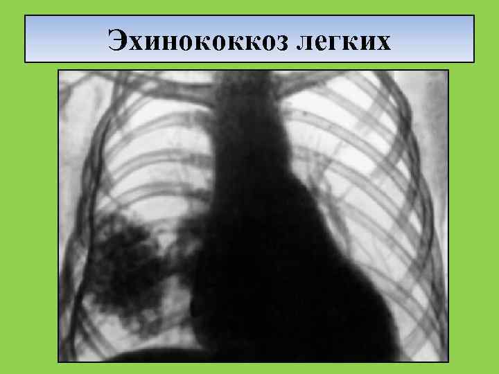 Эхинококкоз легких 