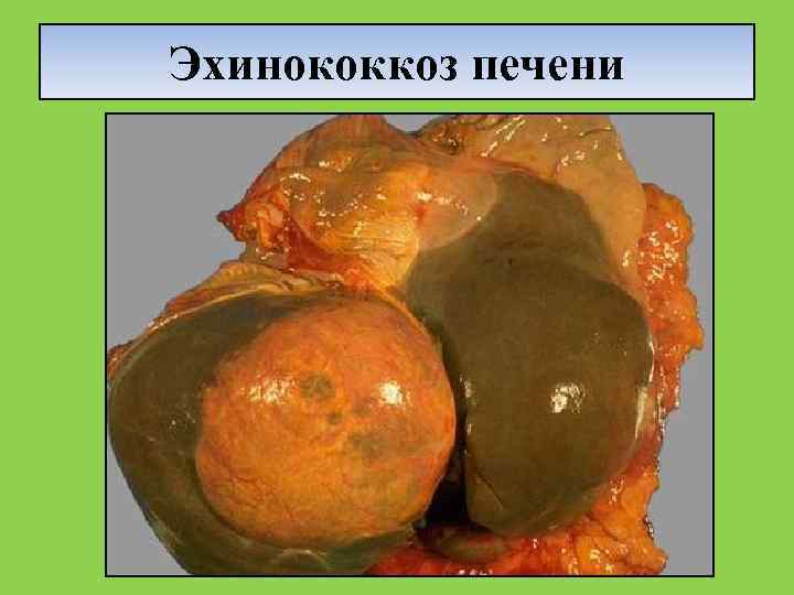 Эхинококкоз печени 