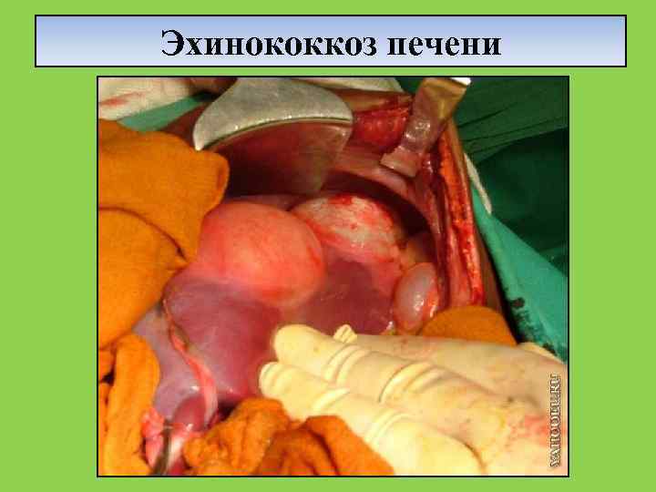 Эхинококкоз печени 