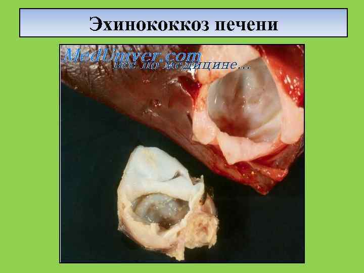 Эхинококкоз печени 