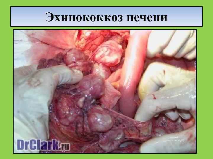 Эхинококкоз печени 