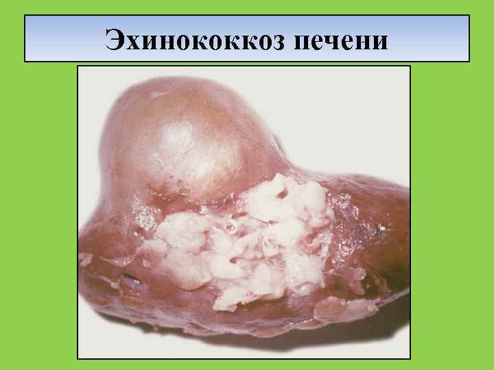 Эхинококкоз печени 