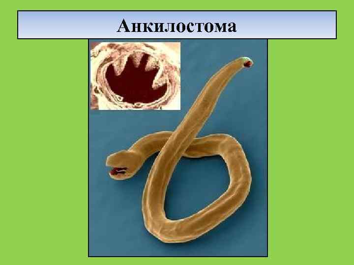 Анкилостома 