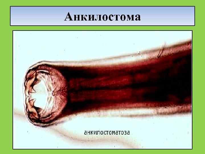 Анкилостома 