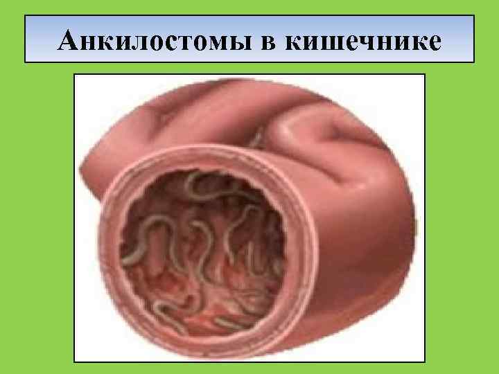 Анкилостомы в кишечнике 