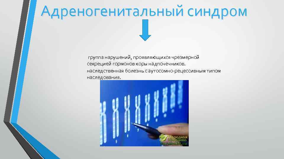 Адреногенитальный синдром группа нарушений, проявляющихся чрезмерной секрецией гормонов коры надпочечников. наследственная болезнь с аутосомно-рецессивным